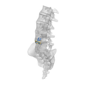 thoraco-lumbar interbody fusion cage