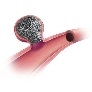 detachable embolization coil