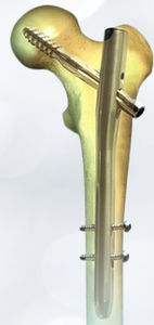 trochanter intramedullary nail