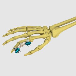 Metacarpophalangeal joint external fixation system - MINISTYLO - MIKAI ...