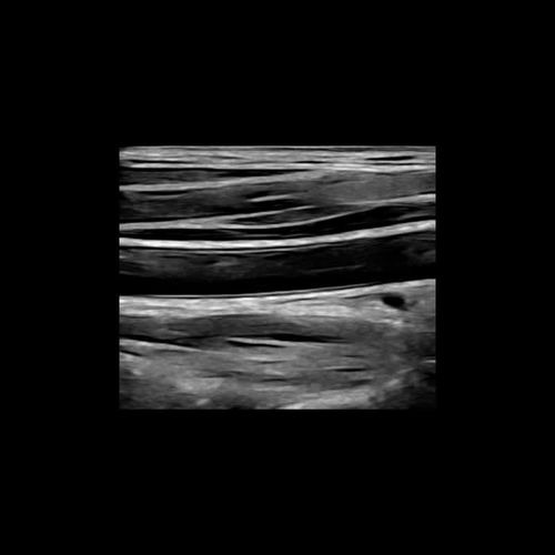 Image enhancement software - Rivent™ Mobile  - ContextVision - for ultrasound imaging