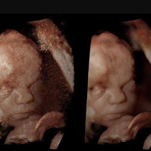 Ultrasound imaging software - Rivent 3D - ContextVision - gynecology ...