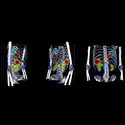 Diagnostic software - Theranostics - Hermes Medical Solutions, Inc - treatment / medical