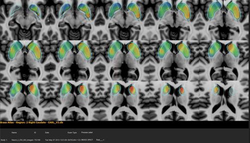 Analysis software - Hermes Medical Solutions, Inc - visualization / medical / PET