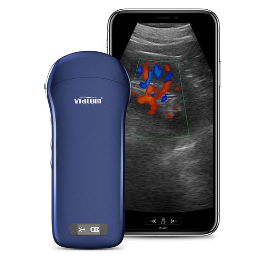 hand-held ultrasound system - Viatom by Lepu