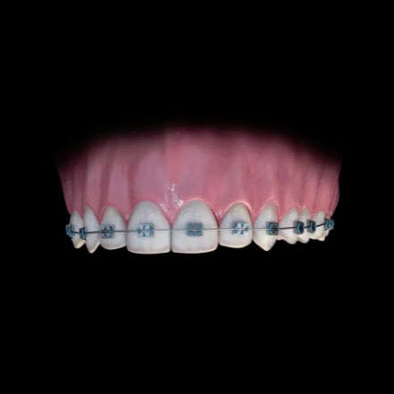 Dental prosthesis design software module - BlueSkyBio - for orthodontics