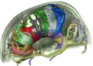 Analysis software - MeVis Medical Solutions AG - planning / for MRI / surgery