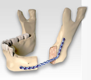 Mandible osteotomy plate - CARCITEK - Global D - locking / metallic