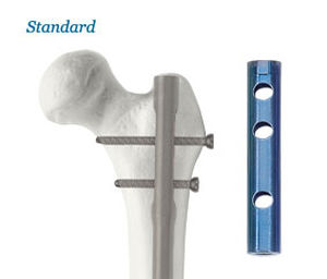 Femoral intramedullary nail - AOS - Advanced Orthopaedic Solutions