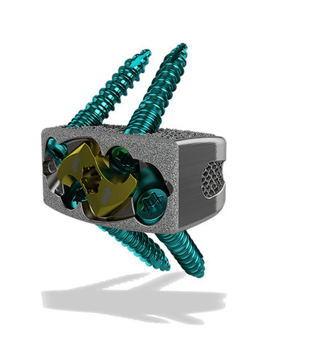 Lumbar interbody fusion cage - Harrier® SA - ChoiceSpine - anterior / titanium / 3D-printed