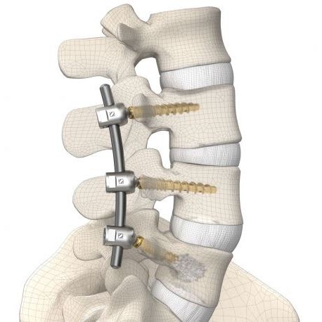 Thoraco-lumbar osteosynthesis unit - DIPLOMAT®  - Signus Medical - posterior / adult