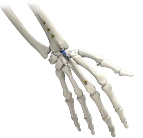 Wrist intramedullary nail - IMPLATE ® - Skeletal Dynamics