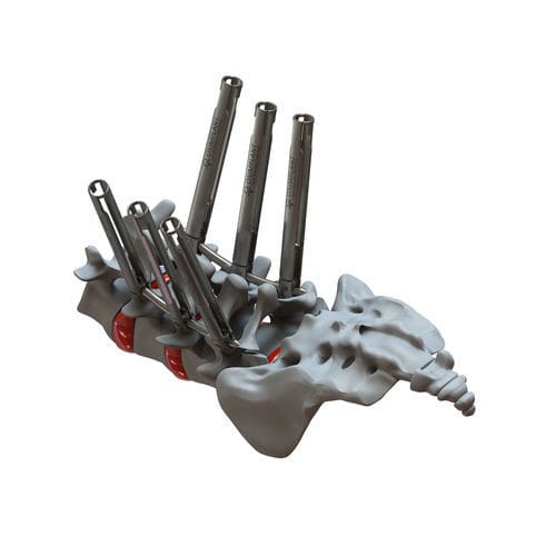 Minimally invasive pedicle screw positioning system - ATHENA - Osimplant