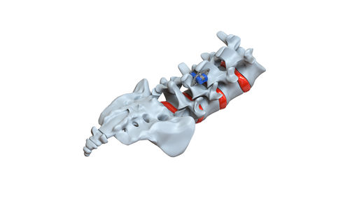 Lumbar interspinous vertebral implant - STRATOS - Osimplant