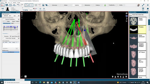Dental implantology software - NemoScan - Nemotec - 3D viewing / analysis / patient data management
