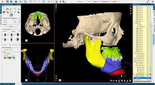 preoperative planning software - Nemotec