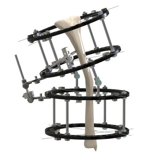 Tibia external fixation system - 11611 series - Canwell Medical - hybrid / adult