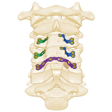 Cervical vertebra laminoplasty plate - Rita - Shanghai Sanyou Medical - vertebra