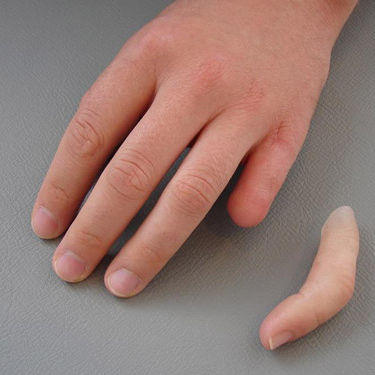 Finger cosmetic prosthesis - schubert and braun prothesenwerk - adult