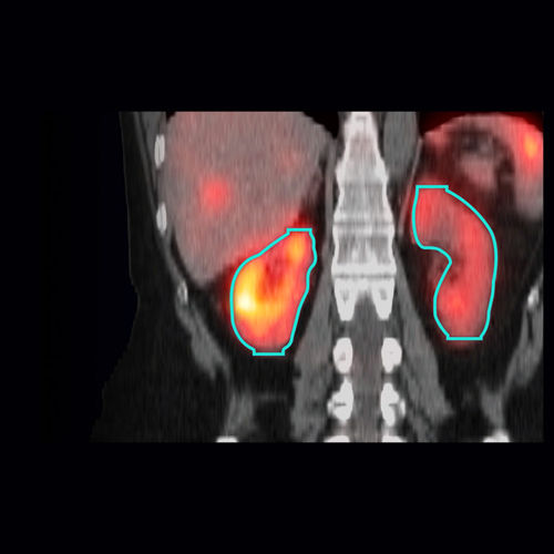 Analysis software - MIM SurePlan™ MRT - Tema Sinergie - visualization / medical / SPECT