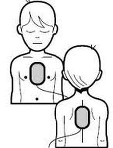 Pad defibrillation electrode - DART Sim ECG Simulator - pediatric / monitoring / chest