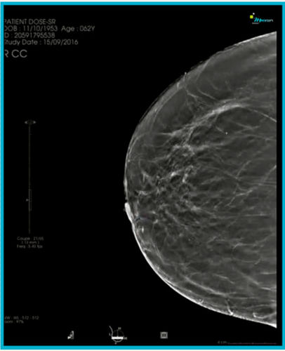 mammography software module - Medecom