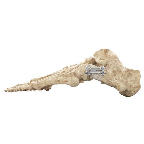 Hallux valgus osteotomy plate - OrthoPediatrics - wrist / foot / ankle