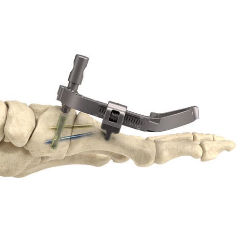 Tarso-metatarsal joint arthrodesis screw - InCore® - Nextremity Solutions - headless