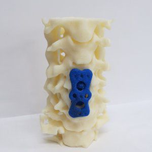 Lumbar vertebral column model - 3D Lifeprints UK Ltd - spine surgery