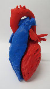 Heart model - 3D Lifeprints UK Ltd - cardiac surgery
