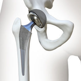 Primary hip prosthesis - MIS - Irene Ortho - cementless