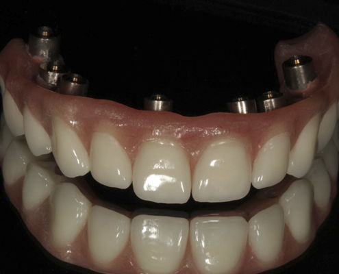 Acrylic dental prosthesis - Screw Retained  - Derby Dental - anterior teeth / posterior teeth