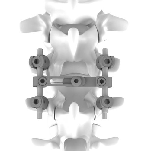 Thoraco-lumbar osteosynthesis unit - K.M. - NEURO FRANCE Implants - posterior / adult