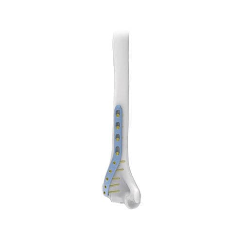 Humerus compression plate - NORMMED Medical Devices - distal / locking / metallic