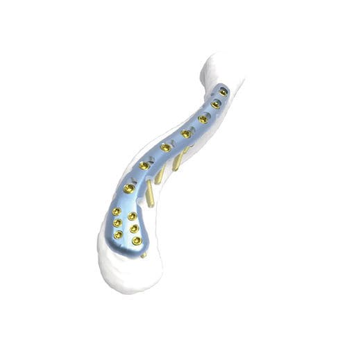 Clavicle compression plate - PNM1001 - NORMMED Medical Devices - distal / locking / metallic