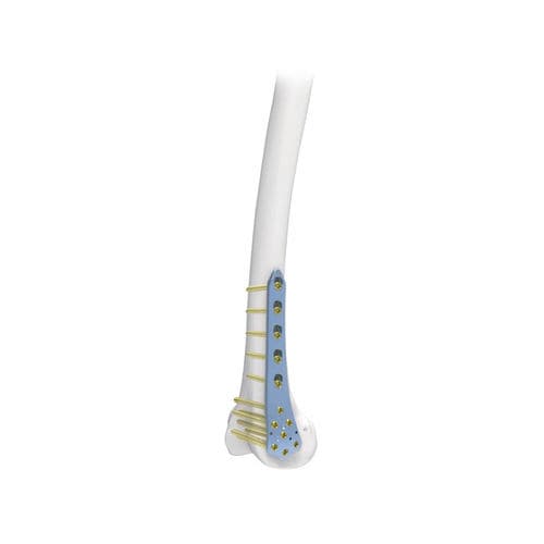Femur compression plate - PNM1022 - NORMMED Medical Devices - distal / locking / metallic