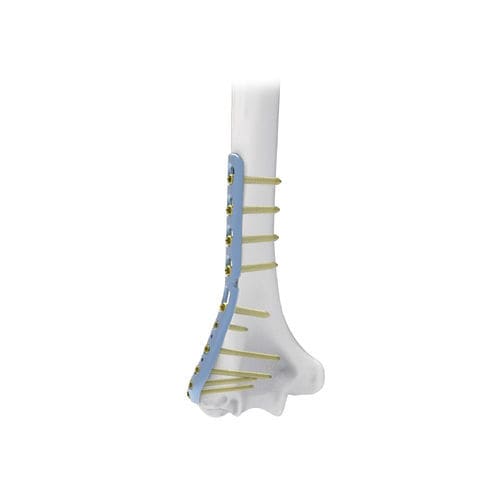 Humerus compression plate - NORMMED Medical Devices - distal / lateral / locking