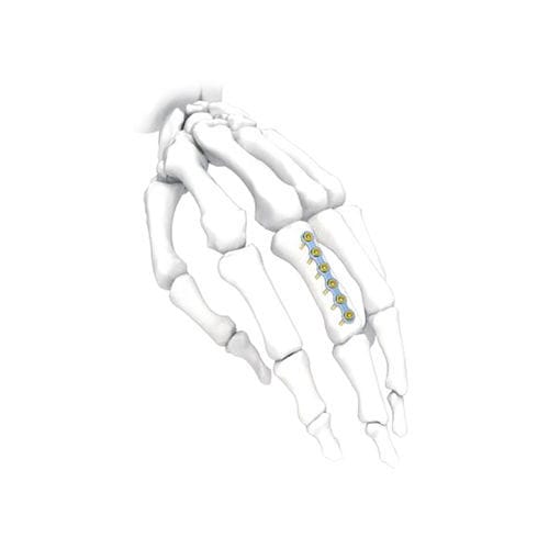 Hand compression plate - PNM5002 - NORMMED Medical Devices - locking / metallic