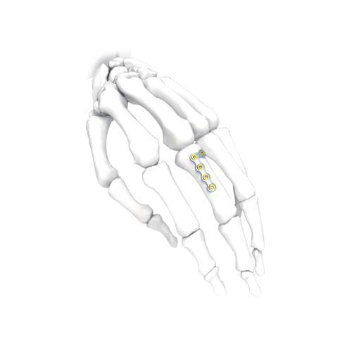 Hand compression plate - NORMMED Medical Devices - locking / metallic