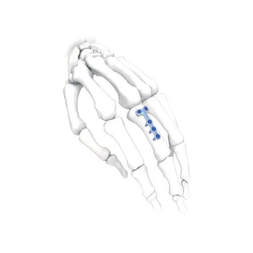 Hand compression plate - T - NORMMED Medical Devices - foot / locking / metallic