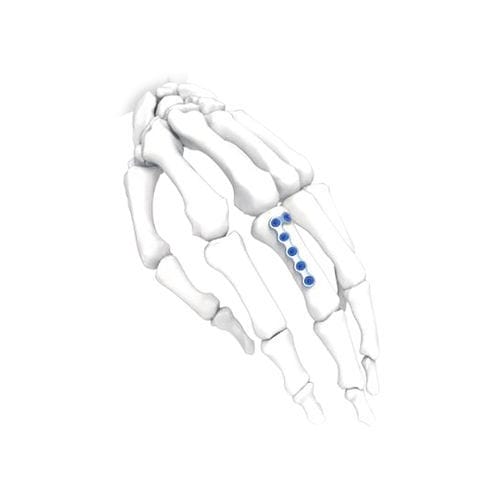 Hand compression plate - PNM5012-100 - NORMMED Medical Devices - foot / locking / metallic