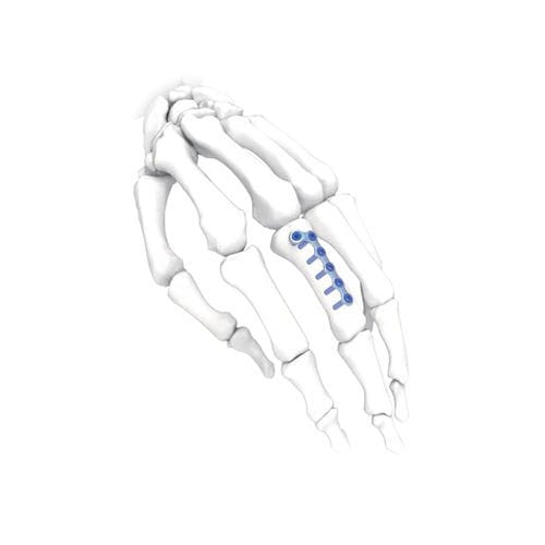 Hand compression plate - L Oblique  - NORMMED Medical Devices - foot / locking / metallic