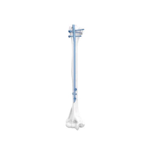 Humeral intramedullary nail - NORMMED Medical Devices - mid-shaft fixation / proximal fixation / metallic