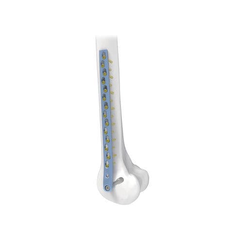 Femoral condyle compression plate - NORMMED Medical Devices - locking / metallic