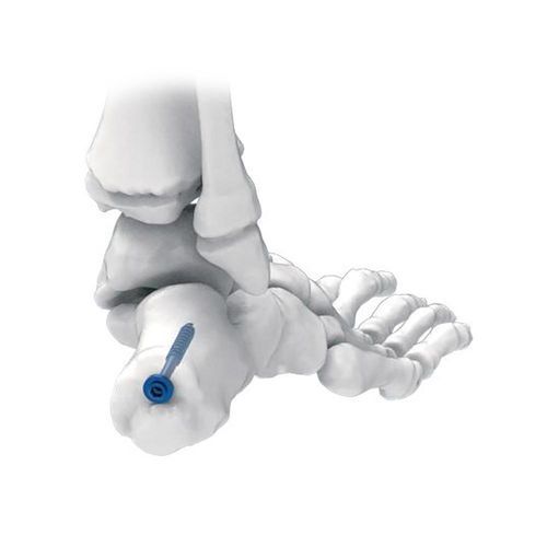 Calcaneus compression bone screw - NORMMED Medical Devices - cannulated / metallic