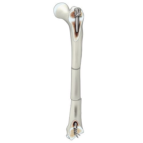 Femoral intramedullary nail - D-SCOPE - Peditst - proximal fixation / distal fixation / pediatric