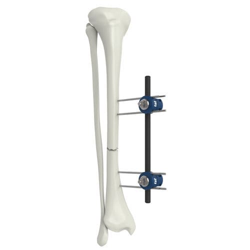 Radius external fixation system - UMEF  - Peditst - tubular / pediatric