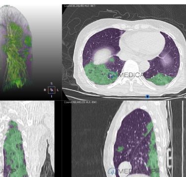 Image analysis software - MEDIP Pneumovid - MEDICALIP Co., Ltd. - visualization / tracking / CT