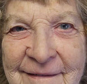 Nasal cosmetic prosthesis - Medical Art Prosthetics - adult