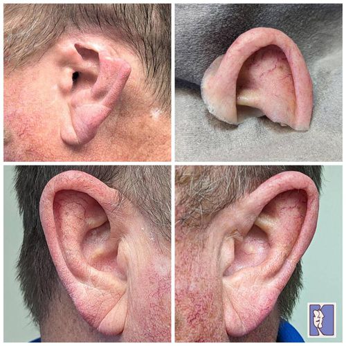 Auricular cosmetic prosthesis - Medical Art Prosthetics - partial / adult